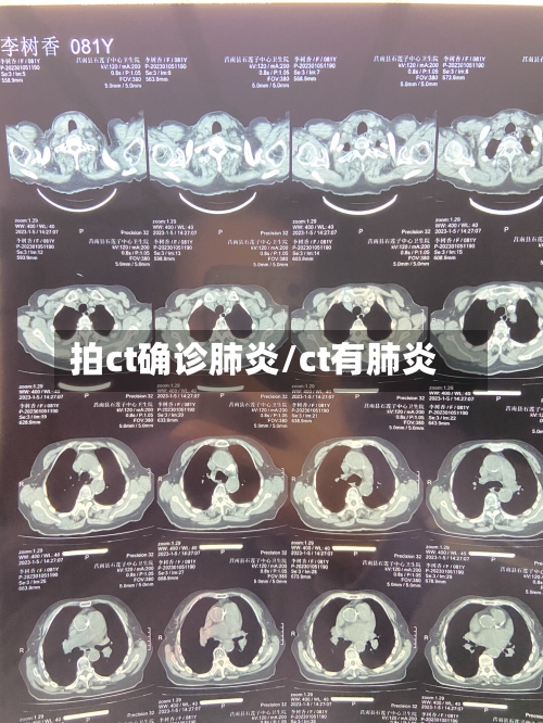 拍ct确诊肺炎/ct有肺炎-第1张图片