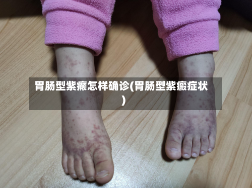 胃肠型紫癫怎样确诊(胃肠型紫癜症状)-第2张图片