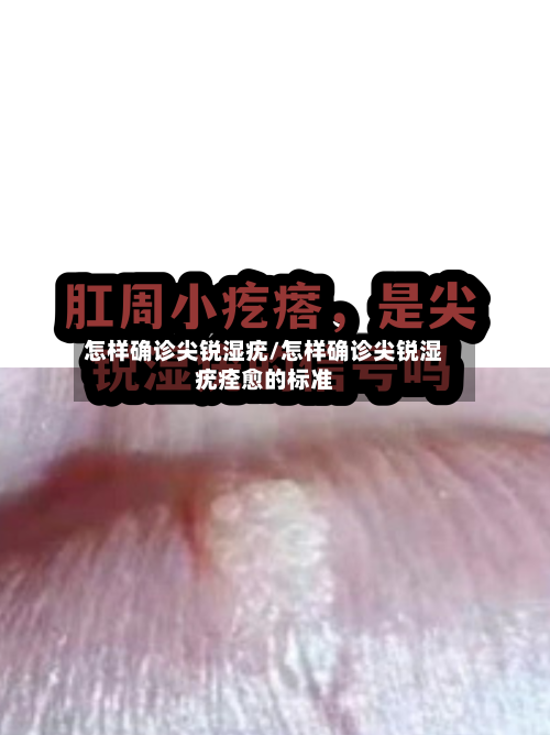 怎样确诊尖锐湿疣/怎样确诊尖锐湿疣痊愈的标准
