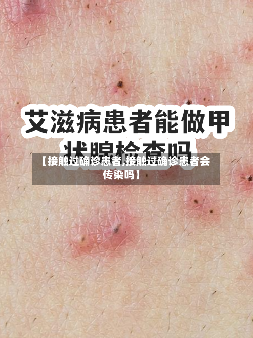 【接触过确诊患者,接触过确诊患者会传染吗】-第2张图片
