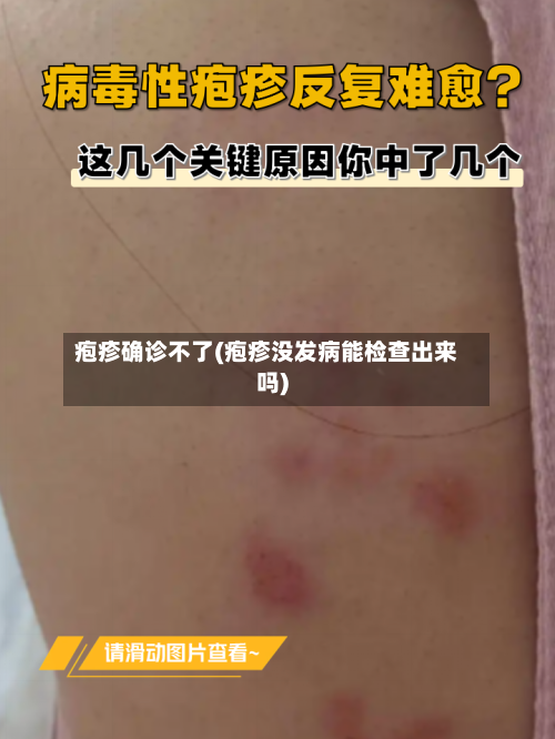 疱疹确诊不了(疱疹没发病能检查出来吗)-第2张图片