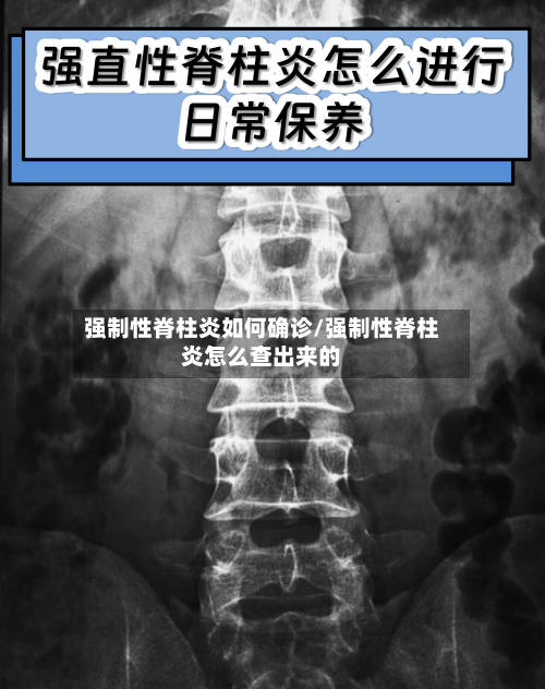 强制性脊柱炎如何确诊/强制性脊柱炎怎么查出来的-第2张图片