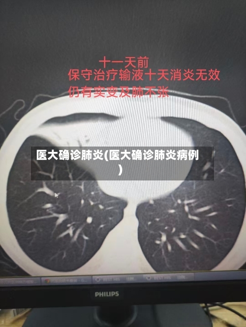 医大确诊肺炎(医大确诊肺炎病例)-第2张图片