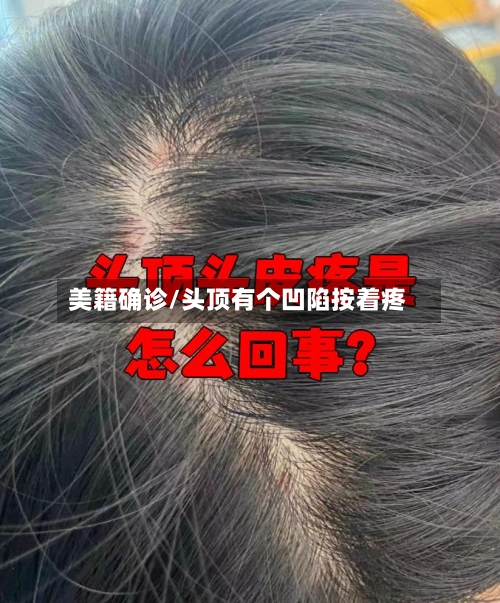 美籍确诊/头顶有个凹陷按着疼-第3张图片
